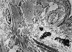 F,17y. | dystrophic calcification in a glial scar F,17y. | dystrophic calcification in a glial scar